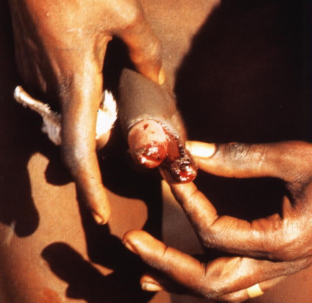 black circumcision
